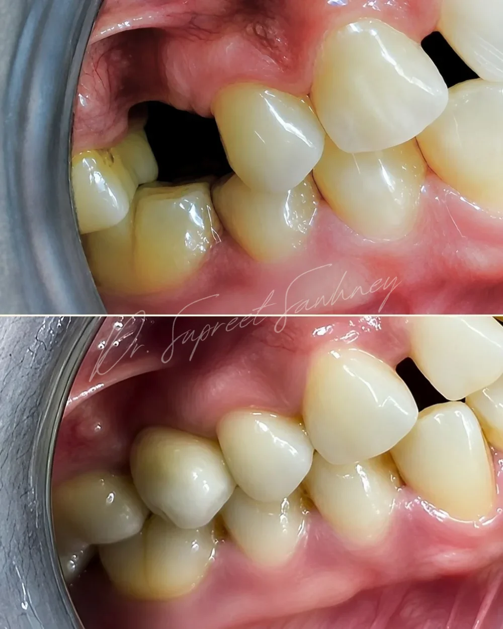 Before-and-after lateral intraoral photographs of a posterior maxillary implant crown restoration